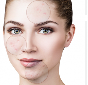 acne aanduiding